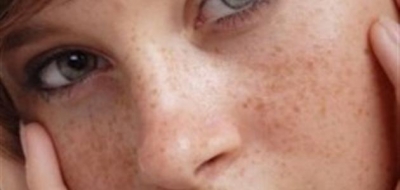 خلطة لإزالة النمش