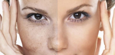 تأثير فصل الشتاء على البشرة