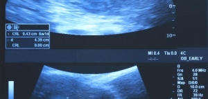 أعراض الحمل في الشهر الأول