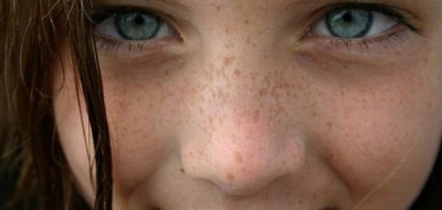 خلطات لازالة النمش